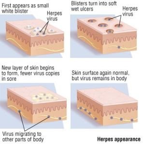 herpes virus 300x298 - Cure For Herpes 2015