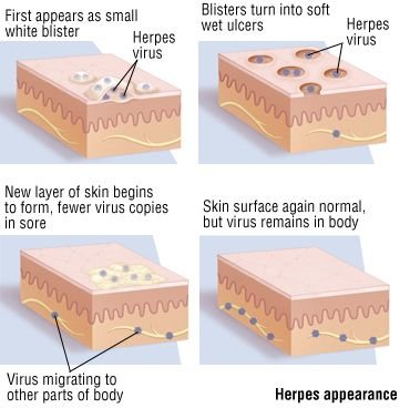 herpes virus - Cure For Herpes 2015