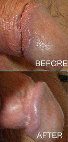 image2ppp - How to remove pearly penile papules at home naturally
